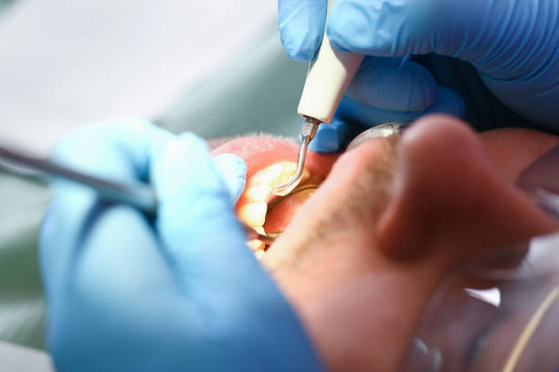 Best Emergency Tooth Extraction in Corcoran, MN