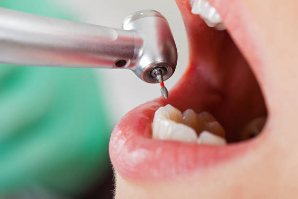Best Emergency Wisdom Teeth Removal in Corcoran, MN
